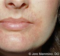 Image result for Rash On Face around Mouth and Nose