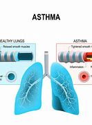 Image result for Allergy Induced Asthma