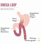 Image result for Omega Loop Bypass