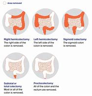 Image result for Colon Cancer Resection
