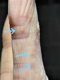 Image result for Flat Wart On Finger