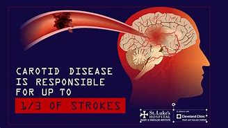 Image result for Carotid Artery Stroke Symptoms