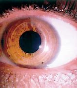 Image result for Refractive Corneal Surgery