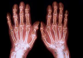 Image result for Rheumatoid Polyarthritis