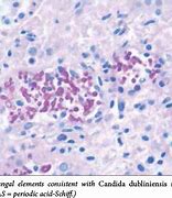 Image result for Disseminated Candidiasis