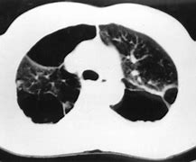 Image result for Marijuana Effects On Lungs