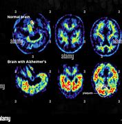 Image result for Brain Images of Those Living with Azlheimers