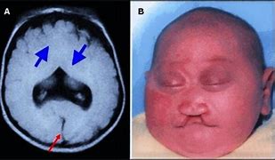Image result for Holoprosencephaly Cyclops
