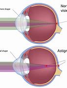 Image result for Astigmatism Eye Vision in Light