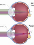 Image result for Astigmatism Rays of Light