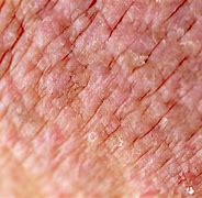 Image result for Eczema Skin Rashes in Adults