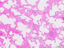 Image result for Interstitial Pneumonia Histology