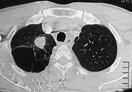 Image result for Spiculated Lung Nodule