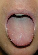 Image result for Warts On Mouth Lips