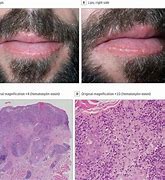 Image result for HIV Lip Sores