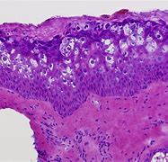 Image result for Epidermodysplasia Verruciformis Surgery
