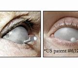 Image result for Intraocular Eye Shields