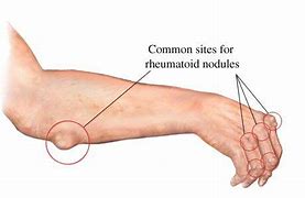 Image result for Forearm Nodules