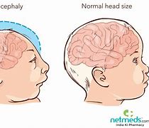 Image result for Primary Microcephaly