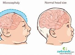 Image result for Microcephaly