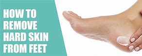 Image result for Harden Skin On Feet