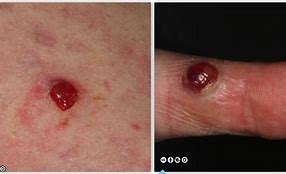 Image result for Warts and Skin Cancer