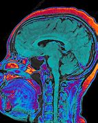 Image result for Normal Shrinking of the Brain