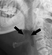 Image result for Thumbprint Sign Epiglottitis