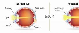Image result for Astigmatism Line in Contacts