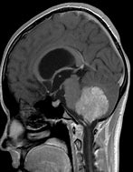 Image result for Choroid Plexus Papilloma