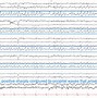 Image result for SSS EEG Pattern