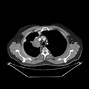Image result for 1 Cm Nodule in Lung