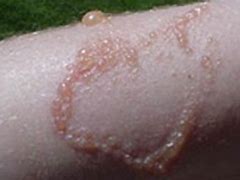 Image result for Manchineel Skin Burn