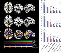 Image result for Brain Abnormalities