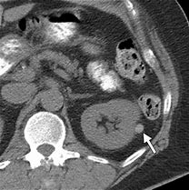 Image result for Haemoragic Renal Cyst MRI