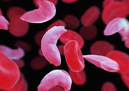 Image result for Anaemia