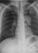 Image result for Abnormal Chest X-Ray