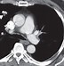 Image result for 2 Cm Nodule On Lung