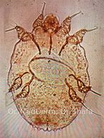 Image result for Scabies Mites On Humans