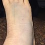 Image result for Jones Fracture Bruising