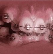 Image result for Pink Chain Braces