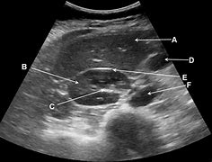 Image result for Abdominal Ultrasound Images Abdomen