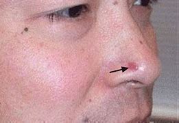 Image result for Bump On Nose Skin Cancer