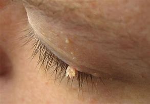 Image result for Warts On Eyes
