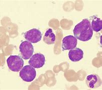 Image result for Lymphoblastic Leukemia