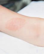 Image result for Poison Ivy Oak and Sumac Rashes