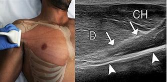 Image result for PEC Muscle Tear