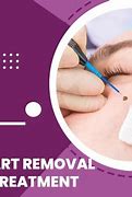 Image result for Wart Removal Surgery