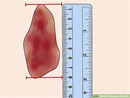Image result for Wound Measure