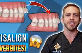 Image result for Byte Aligners Overbite